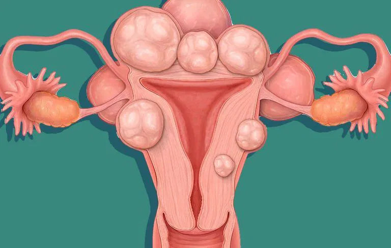 Symptoms of Uterine Fibroids and Their Impact on Menstrual Periods
