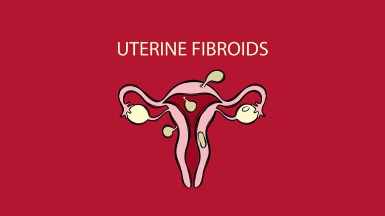 The Truth About Uterine Fibroids: Causes, Symptoms, and Natural Solutions